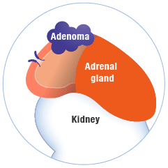 adrenal gland and tumor