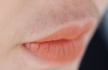 Image of abnormal hair growth caused by hypercortisolism called hirsutism