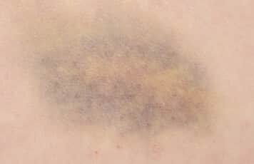 Image of abnormal bruising caused by hypercortisolism
