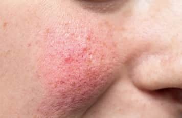 Image of facial redness caused by hypercortisolism called plethora