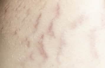 Image of bruising caused by hypercortisolism called striae